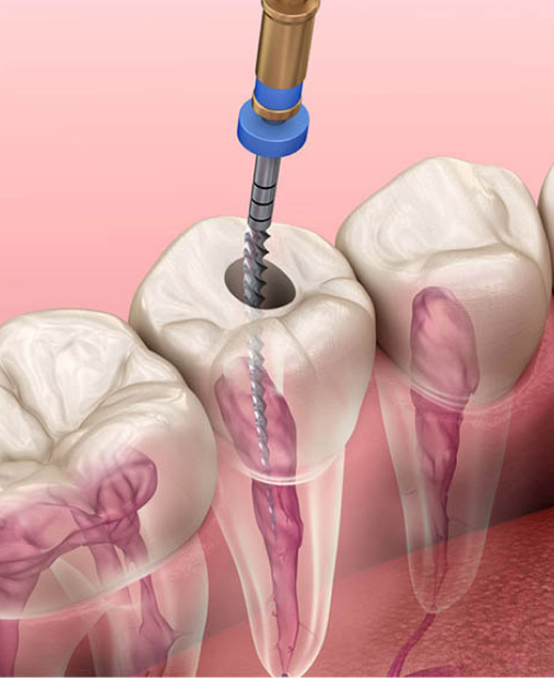 根管治療